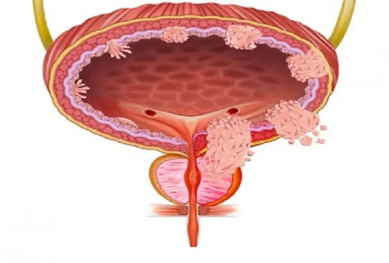 Bladder Cancer