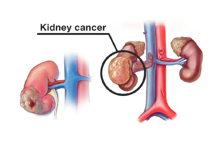 Kidney Cancer